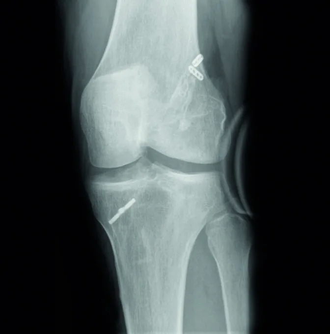 Postoperative xray 01